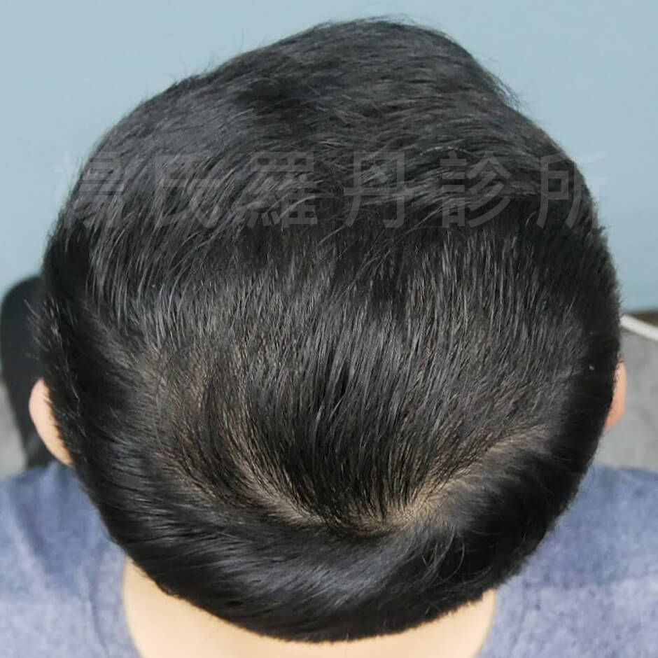 生髮 雄性禿 楊氏羅丹 植髮